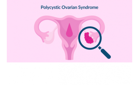 Polysctic Ovarian Syndrome